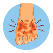 Plantar Fasciitis