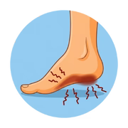 Neuropathy