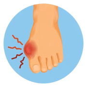 Foot Swelling